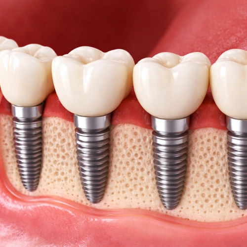 Multiple Teeth Implants